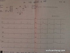 麦迪森健康：体检查出这些心电图结果异常，别慌张，或无需治疗