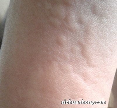 湿疹和过敏 该怎么判断