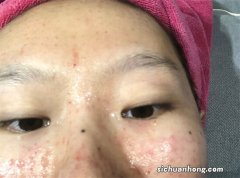 拿捏住这几个“重点”，打水光针事半功倍