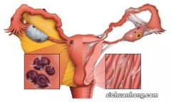 女人摘掉子宫后，和正常的女性有何不同呢？不妨了解
