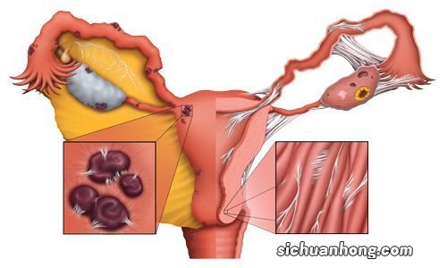 女人摘掉子宫后，和正常的女性有何不同呢？不妨了解