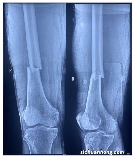 代谢性骨病的影像学表现：佝偻病和骨软化症Rickets and Osteomal