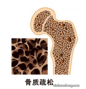 13岁女孩摔跤后来杭州检查，一查全身骨头都在溶解