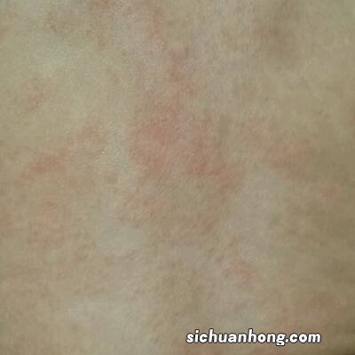 宝宝长了湿疹瘙痒难受,宝妈应该这么做