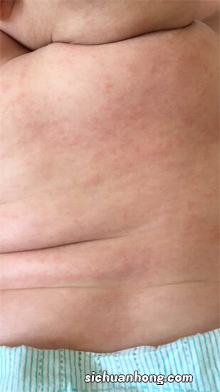 宝宝是否有湿疹如何判断?怎么预防婴儿湿疹?