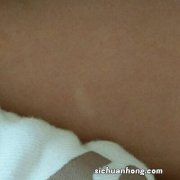 新手爸妈很好奇，宝宝的血管瘤“发白”是变严重出现的并发症？