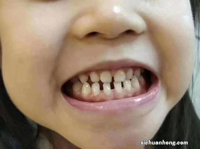 你家宝宝的牙齿“长对”了吗？