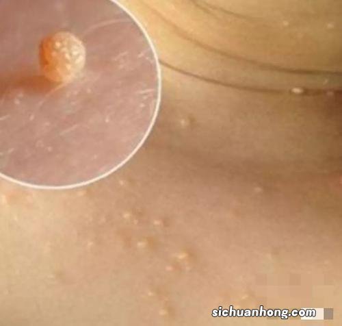 腋下和脖子下面的“小肉粒”究竟是什么？能不能直接用手揪掉？