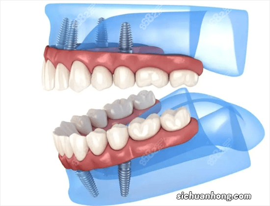 种植牙和镶牙哪种使用寿命更久？