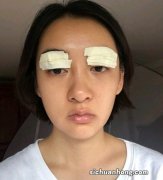 江苏：中年男子割双眼皮，卧床休息不下地像坐月子，超搞笑