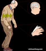 ?年轻人也会得帕金森病吗？
