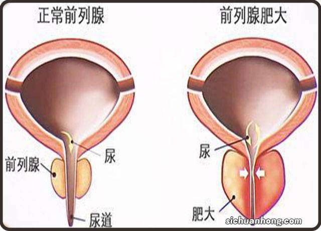 男人尿频是怎么回事?病因还不少,归纳起来便是这3点