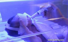 黄疸晒太阳时是晒什么部位？