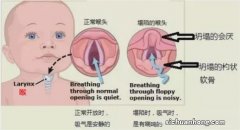 孩子怎么就突然出现喘息了？怎么引起的？该如何是好