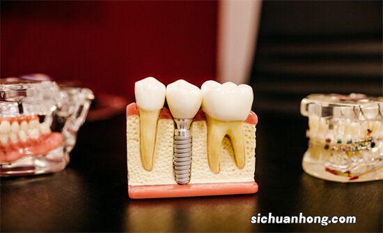 牙齿缺失后，陷入镶牙or种牙之间难以抉择？良心牙医告诉你怎么选