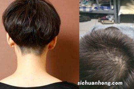 新生儿婴儿脑后勺头发秃光，流传的说法是缺钙，真的是如此吗？