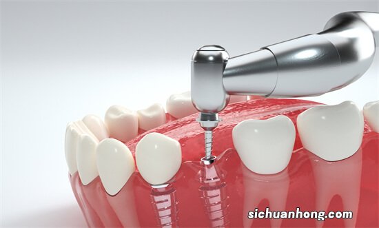 「牙齿那些事儿」No.115丨预算几千元，还可以做种植牙吗？