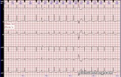 权威解答 心脏有时候突然跳得很快，到医院查心电图又是正常的，怎么办？