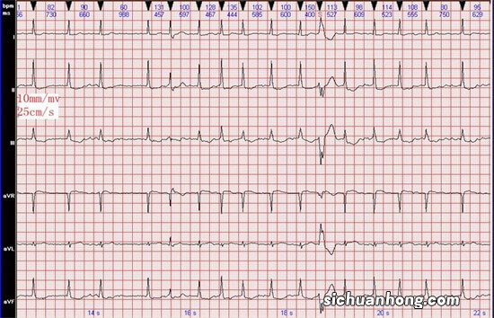 权威解答 心脏有时候突然跳得很快，到医院查心电图又是正常的，怎么办？
