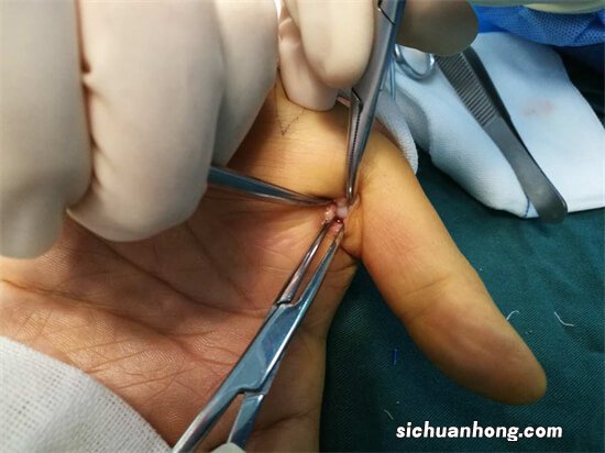 宝宝复杂并指分指手术不需要植皮 有并指免植皮技术可以选择