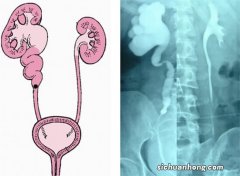 17岁少女拥有4个肾 多出来的两个肾能捐吗？