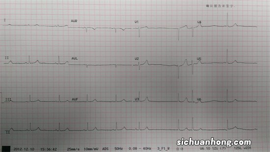 Holter 揭谜：去医院做普通心电图和动态心电图到底哪个好？