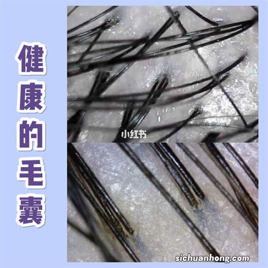 你不知道的头发秃顶的五大原因和改善方法