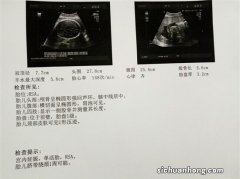 面对这次新型肺炎，孕妇该如何有效的保护自己及胎儿？