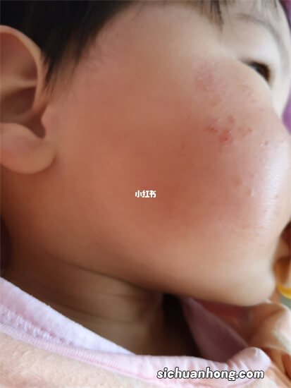 宝宝湿疹反复发作应该怎么办？