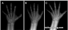 我来告诉你骨龄是什么？怎么知道孩子的骨龄