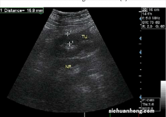 彩超为啥出来的是黑白图像？