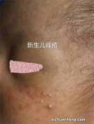 朋禾妈妈来答疑，新生儿也会长“青春痘”？