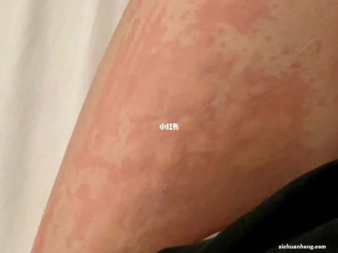 宝宝得荨麻疹是什么原因造成的?