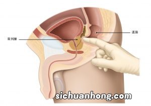 医院里让人娇羞的“肛门指检”，戳一次能查4个地方，还可预防癌