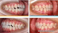 30岁真的还可以矫正吗？年龄大矫正还有效果吗？