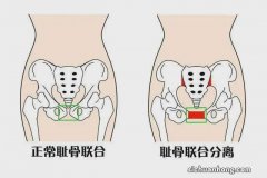 女性耻骨凸起可能有那些原因？