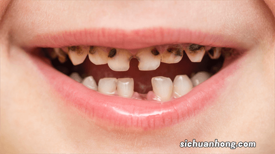 喝可乐会“腐蚀”牙齿?这几类食物,可能比糖还“毁牙”