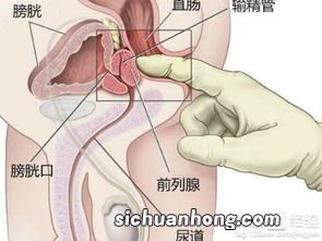 怎么判断自己是不是得了慢性前列腺炎？