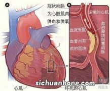 心肌缺血有哪些症状