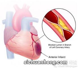 心肌梗死具体是如何病发的？