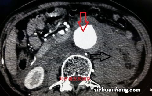 主动脉瘤是怎么致使死亡的？