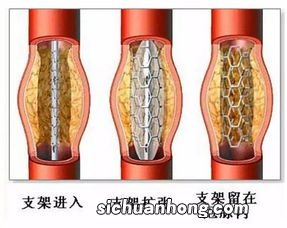 心脏支架的制造历史