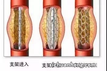 心脏支架置入，有3个适应症