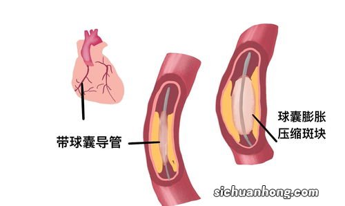 心脏支架是被美国淘汰的技术吗？