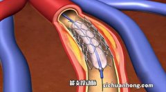 心脏支架的基本知识