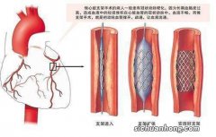 心脏支架的类型