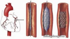 一起了解，心脏支架植入后的并发症和处理