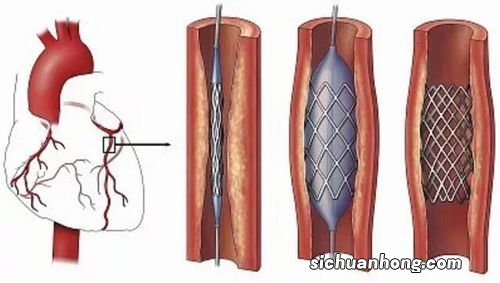 一起了解，心脏支架植入后的并发症和处理