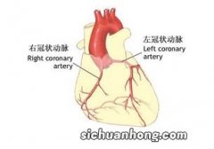 为何说冠状动脉狭窄会比钙化更严重？