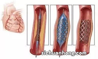 国外已经停用心脏支架手术多年？